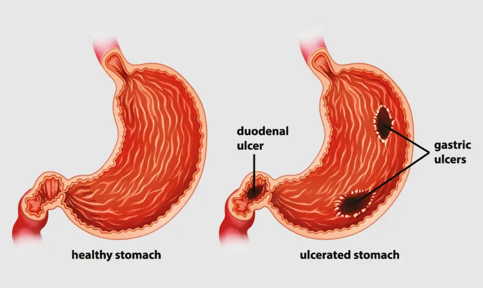 Peptic ulcers healthy vs ulcerated stomach