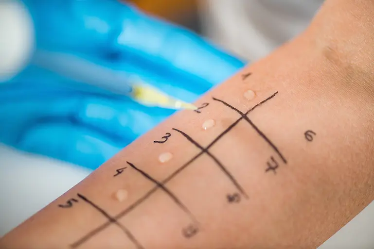 Skin Test Skin Prick Allergy Test for Children - Paediatric Healthcare